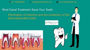 Root Canal Treatment Save Your Teeth